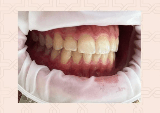 tipuri culoare dinti