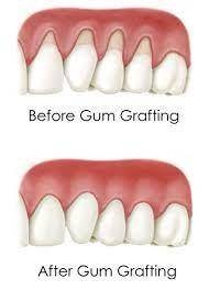 retractie gingivala