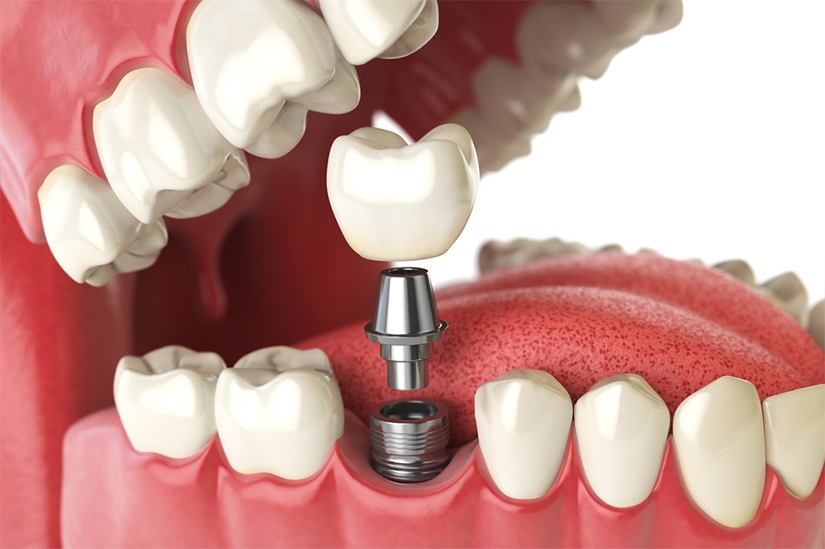Reabilitare totală cu dinți ficși pe implanturi dentare și ghid chirurgical 3D la Clinica Dr. Kurbe