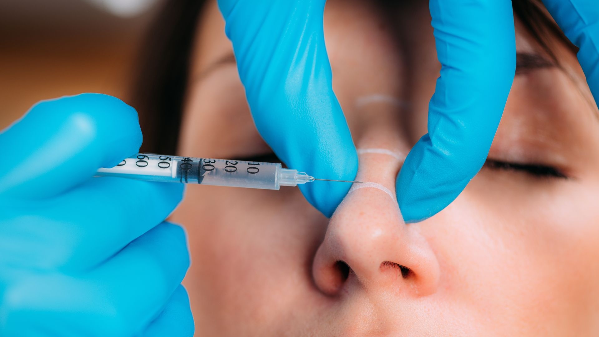Rinocorecție nechirurgicală cu acid hialuronic pas cu pas la Clinica Dr. Kurbe