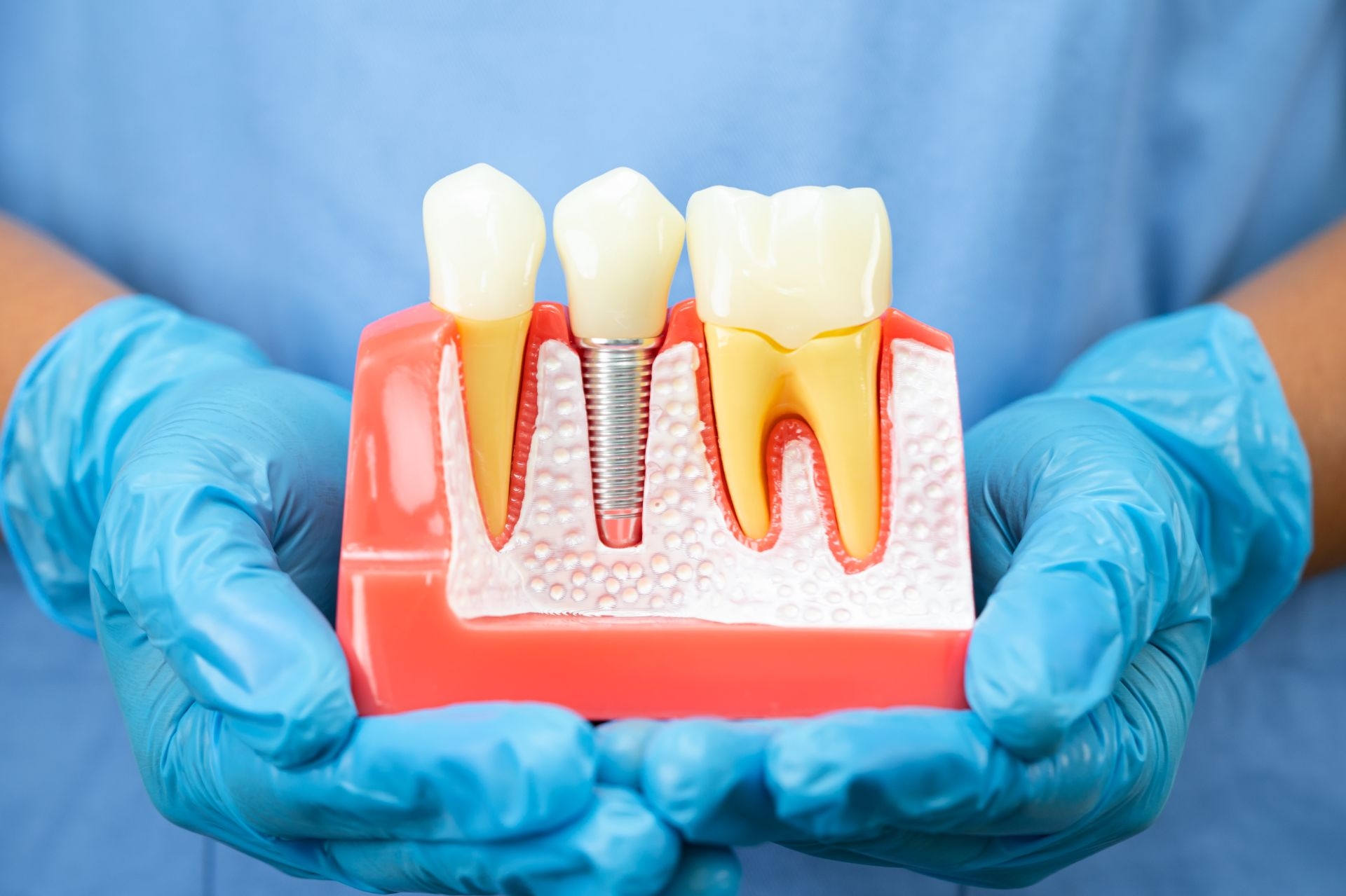 Implant dentar versus proteză mobilă - comparație clinică la Dr. Kurbe București