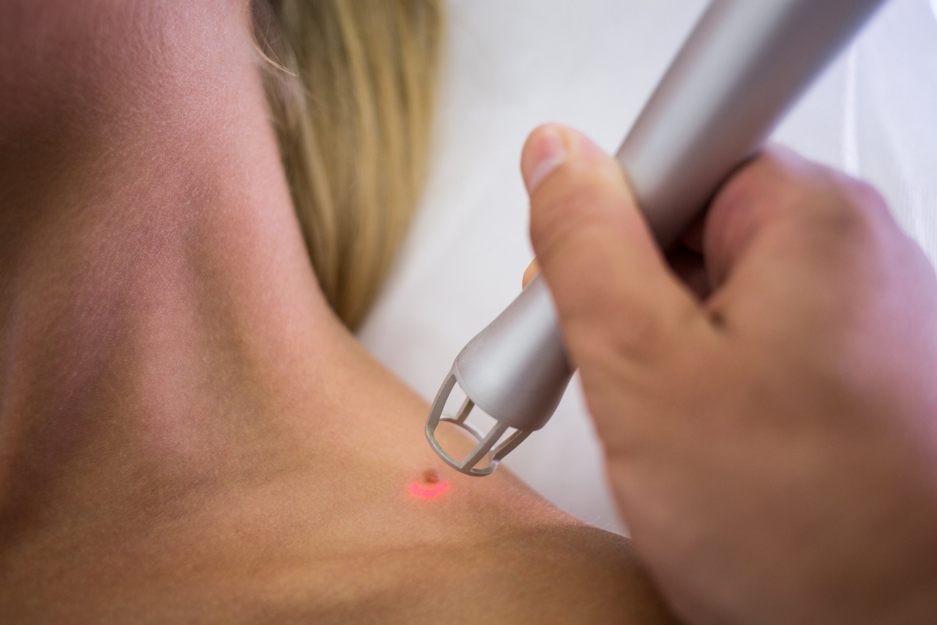 Rejuvenare faciala si tratament cicatrici cu laser fractional CO2 la Clinica Dr Kurbe Bucuresti