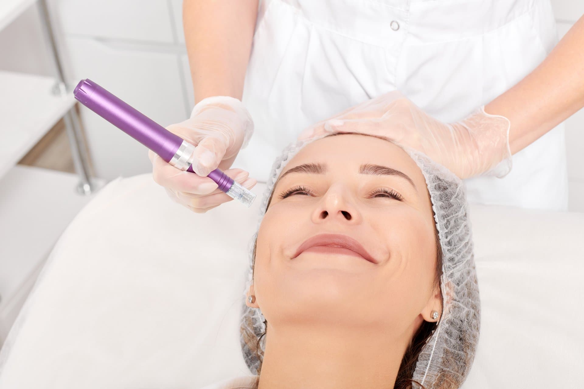 Exosomes cu Microneedling Nanopores