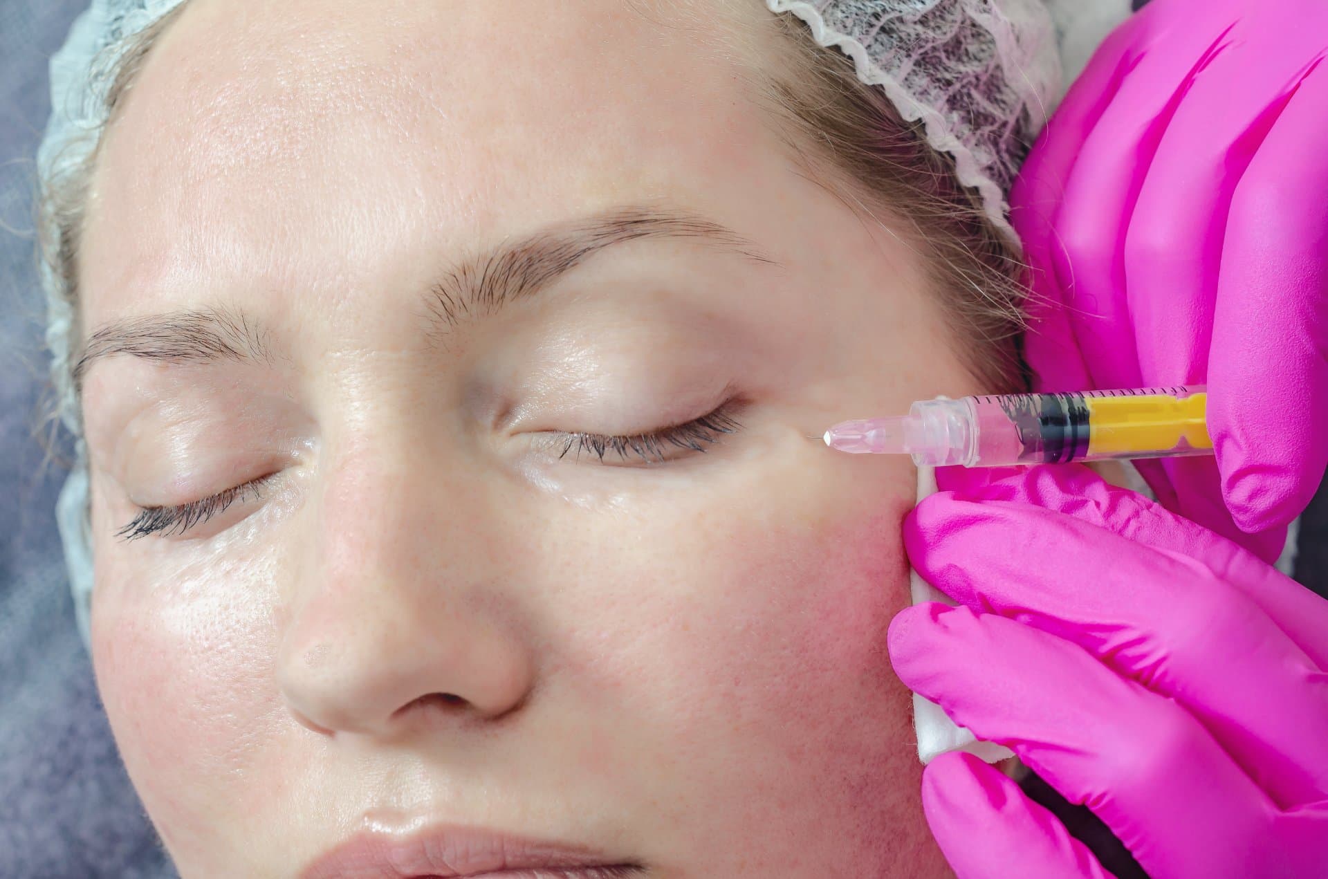 Bunny lines cu toxină botulinică