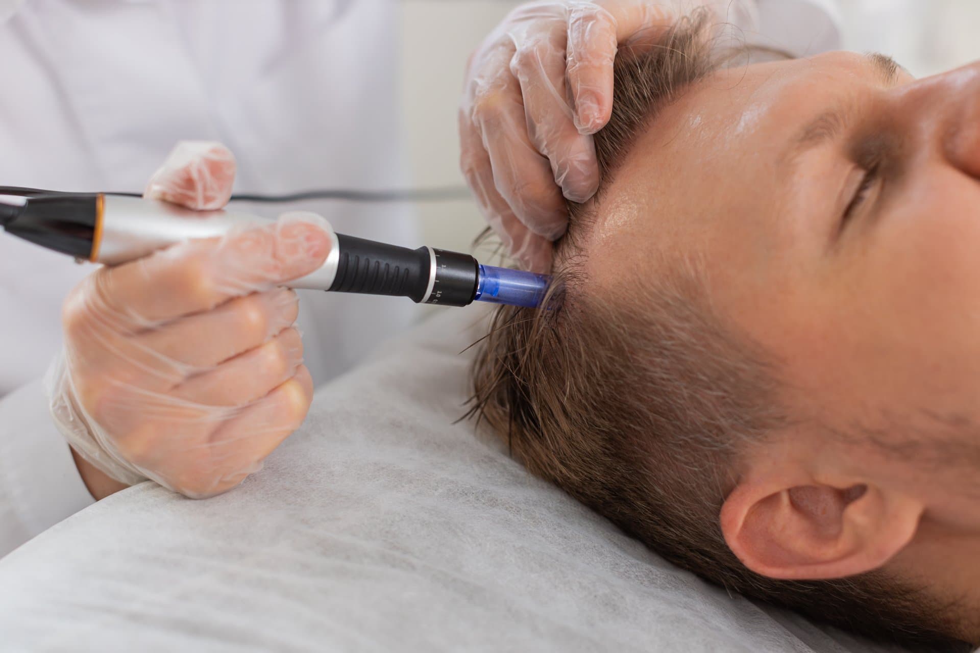Microneedling pentru scalp cu fiolă de cupru