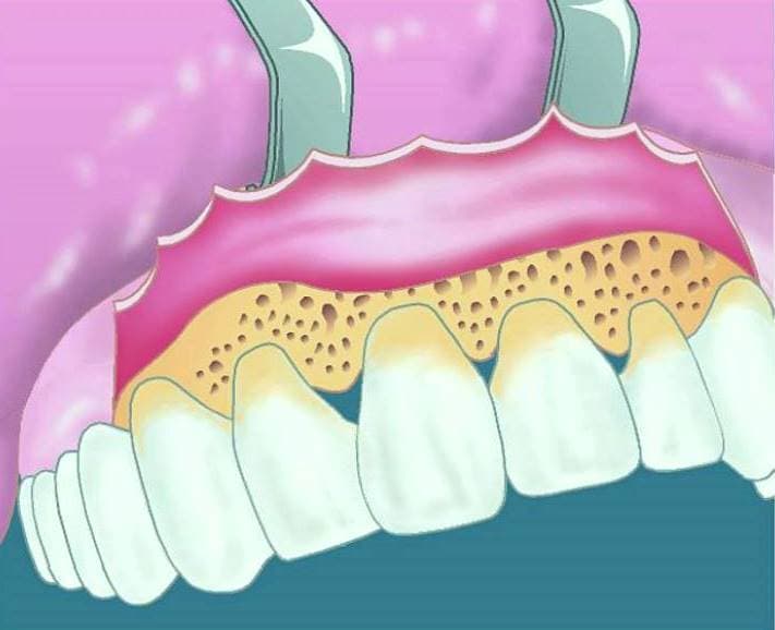 tartrul si boala parodontala