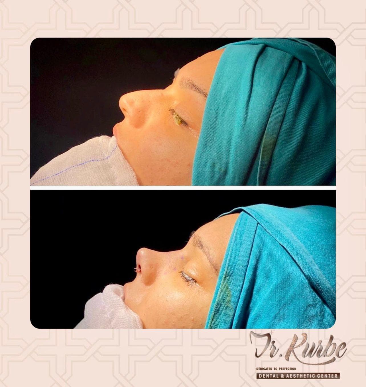 nas inainte si dupa rinoplastie