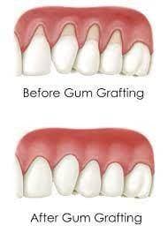 retractie gingivala