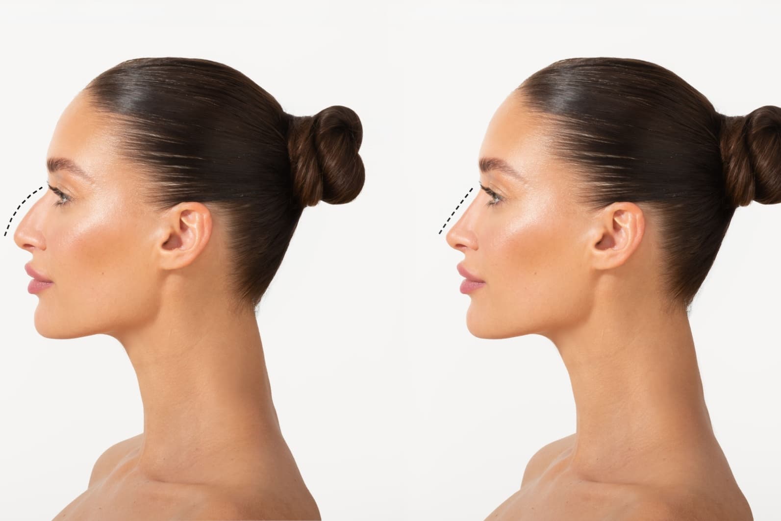 Rinoplastie nechirurgicala vs. rinoplastie chirurgicala