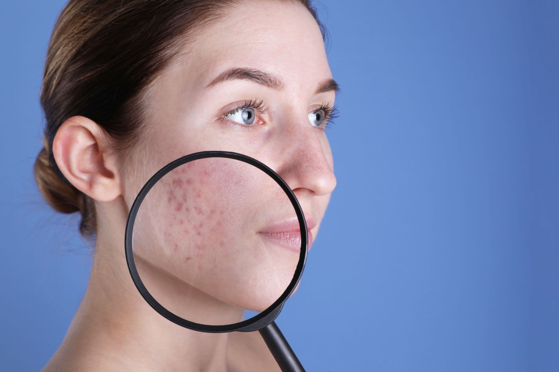 Tratament dermatologic pentru acnee si cicatrici post-acnee la Clinica Dr. Kurbe
