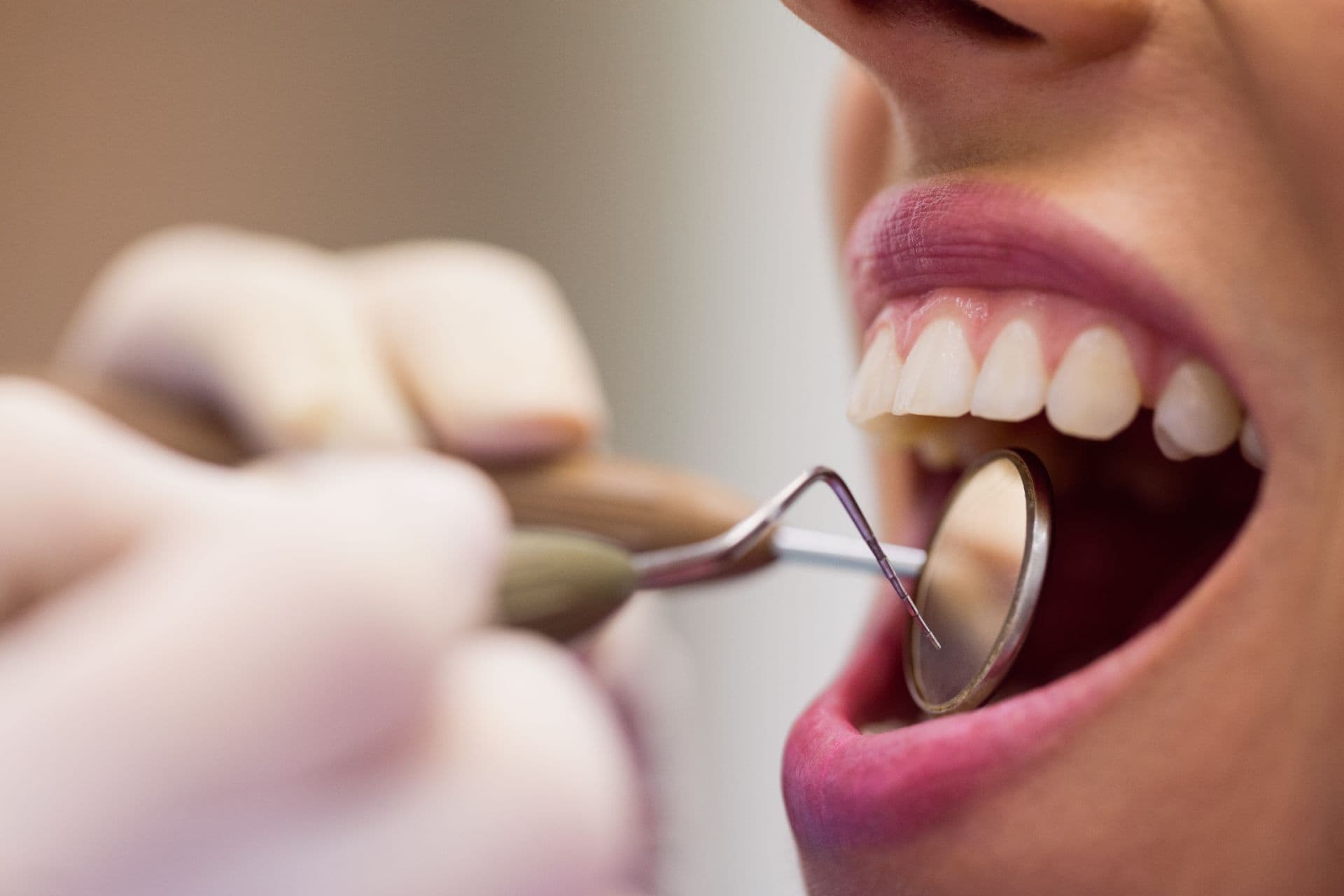 Tartrul dentar si boala parodontala detartraj cu ultrasunete Clinica Dr Kurbe
