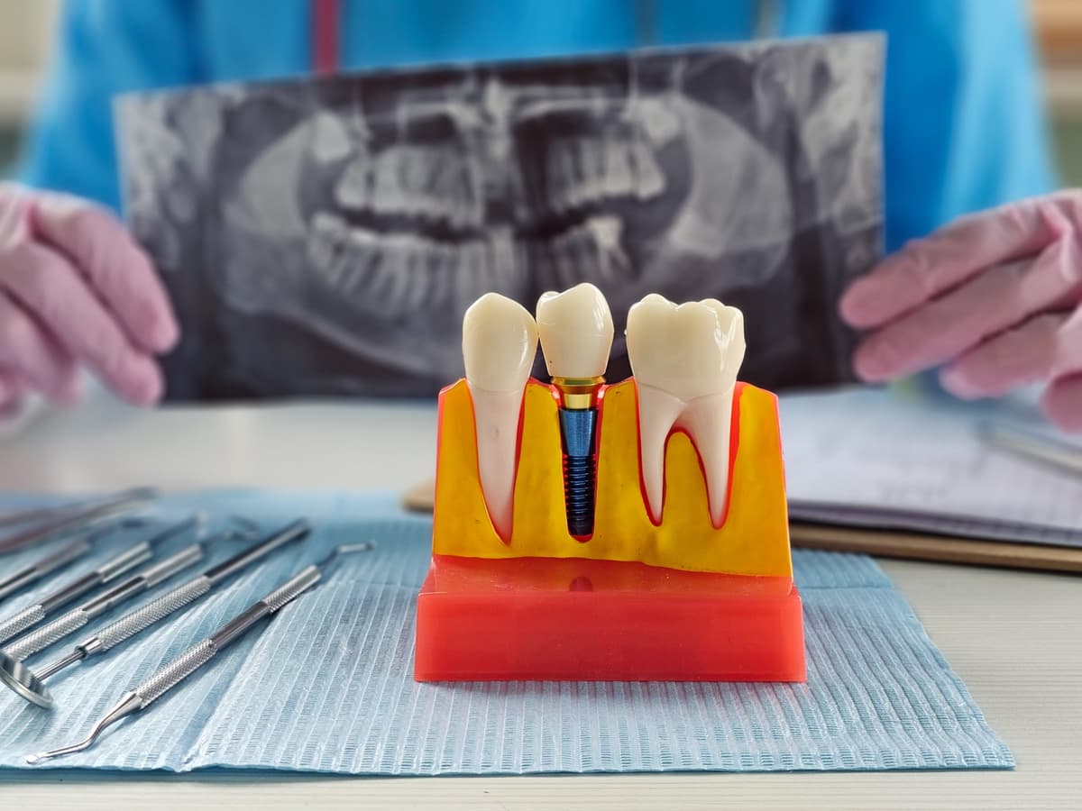 Principiile și tehnica regenerării osoase ghidate (GBR)