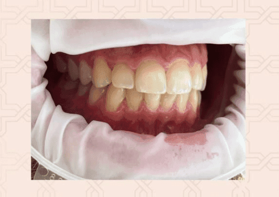 tipuri culoare dinti