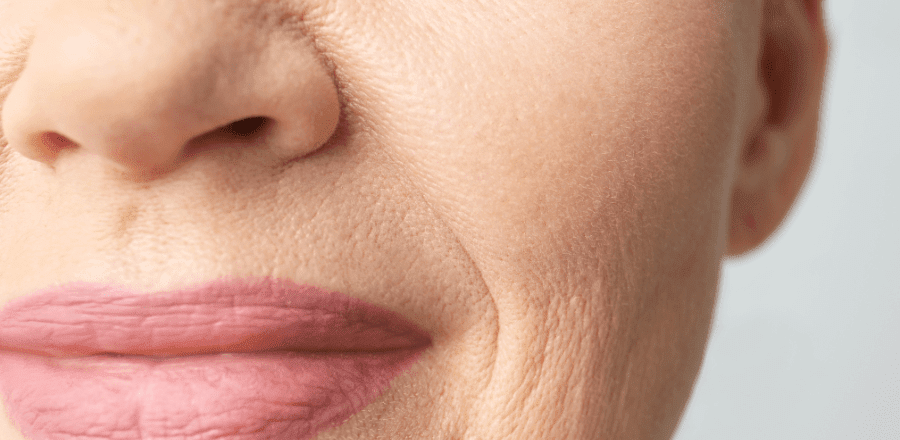 Smoker Lines - Ridurile deasupra buzei superioare și cum să le tratezi