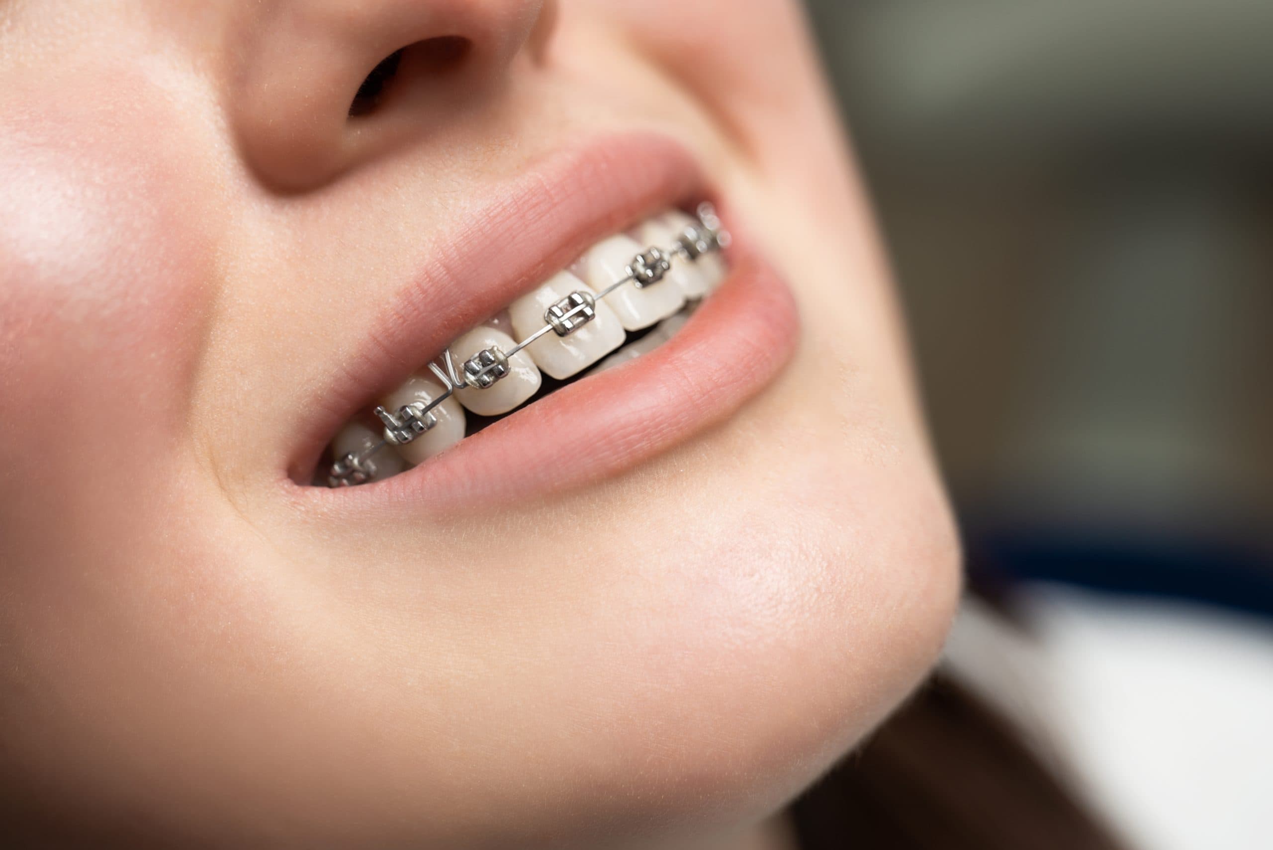 woman with braces