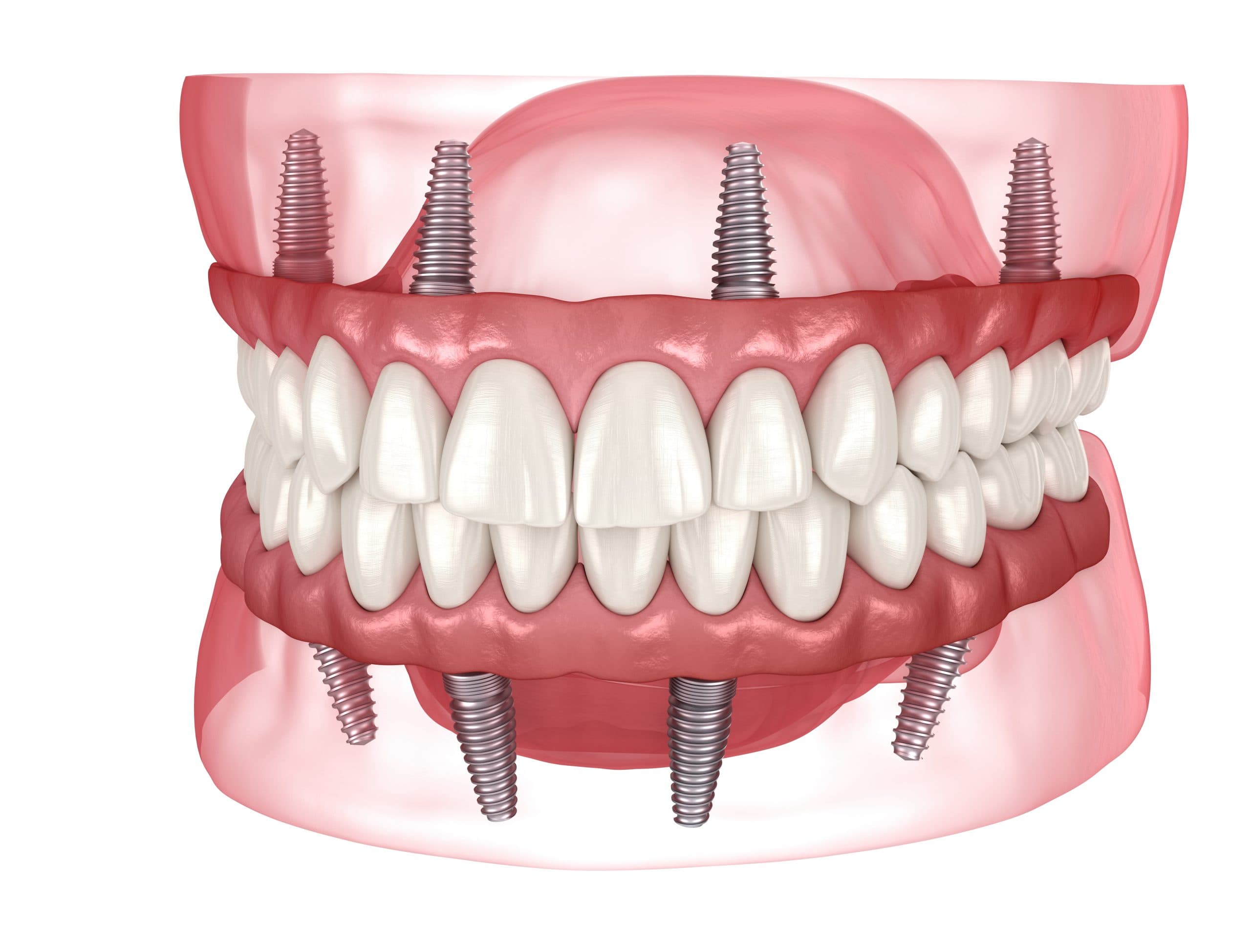 Dental,Prosthesis,Based,On,4,Implants.,Dental,3d,Illustration