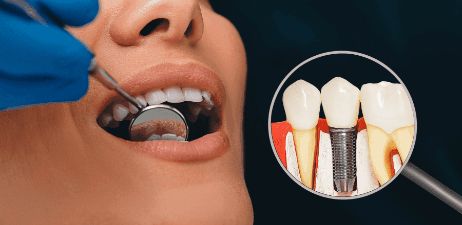 Pacient cu lucrare dentară fixă pe implanturi, tip All-on-4, la clinica Dr. Kurbe