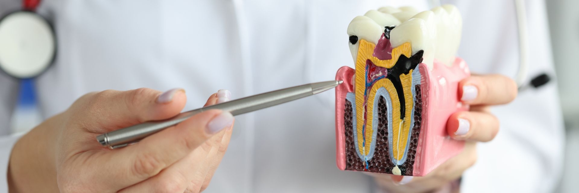 Tratament de canal endodontic