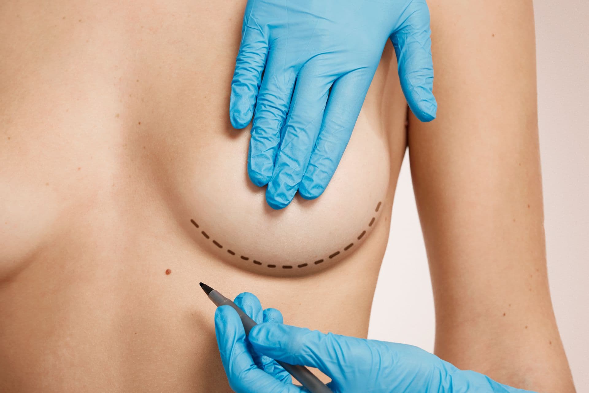 Tipuri de implant mamar cu gel siliconic coeziv și abordul chirurgical la Dr. Kurbe Center