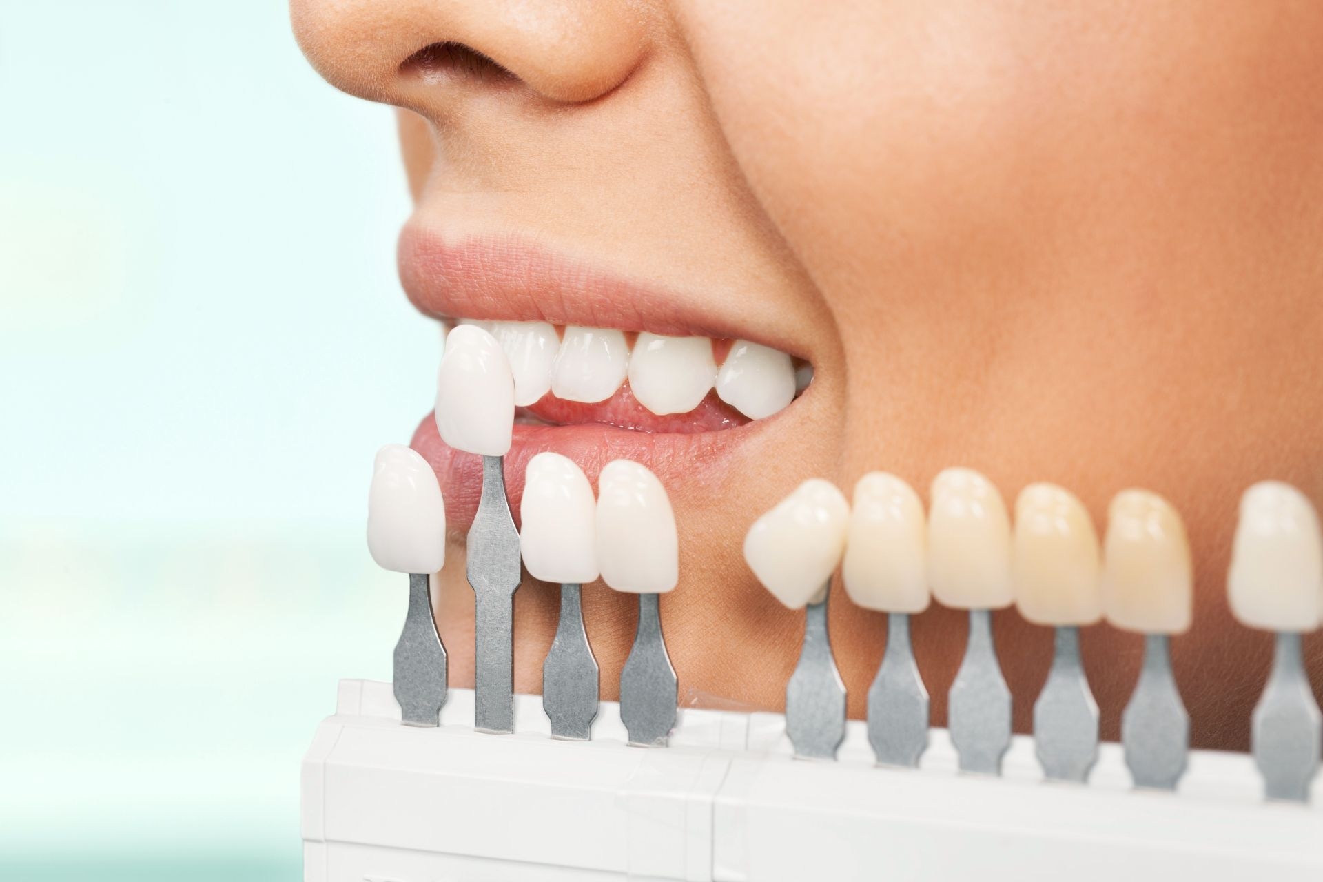 Fațetă dentară vs. coroană dentară – comparație la Dr. Kurbe București