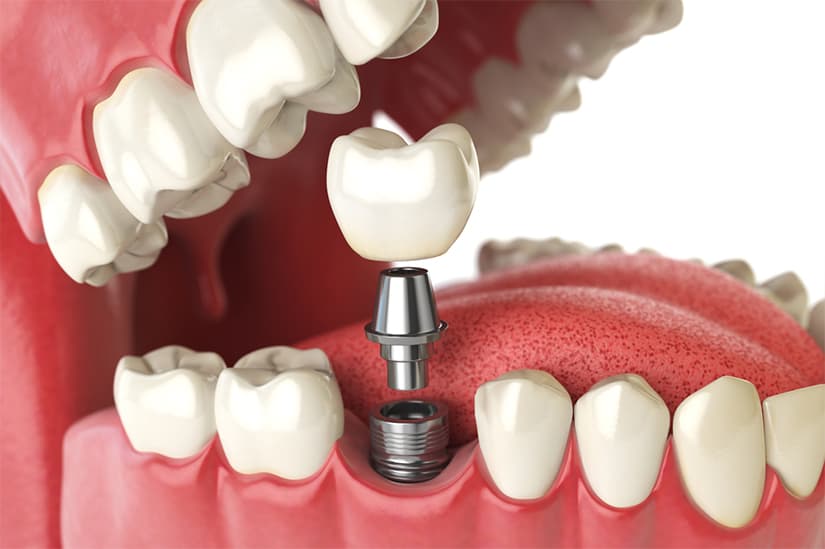 Reabilitare totală cu dinți ficși pe implanturi dentare și ghid chirurgical 3D la Clinica Dr. Kurbe