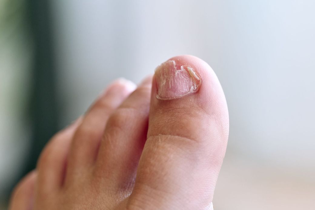 Unghie sanatoasa in proces de regenerare completa dupa tratament dermatologic