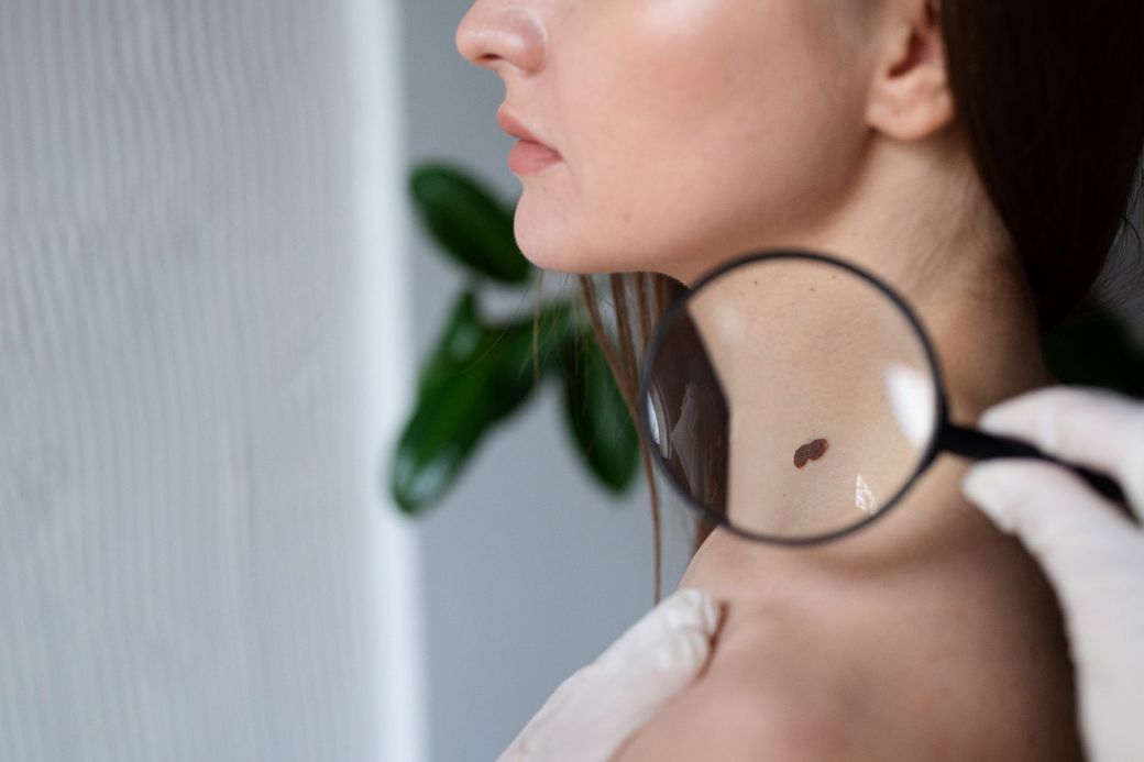 Examinare dermatoscopica digitala a alunitelor suspecte la Clinica Dr. Kurbe