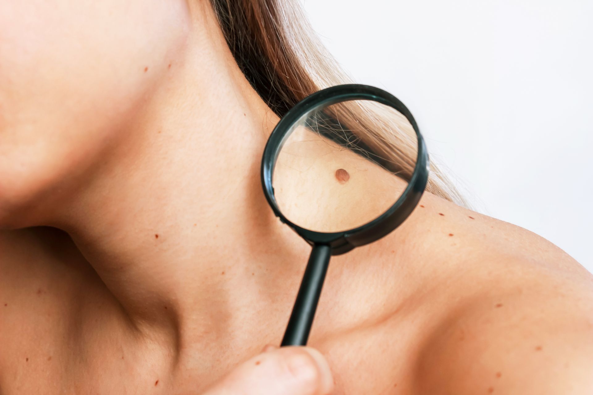 Evaluare dermatoscopică a alunițelor la Clinica Dr. Kurbe