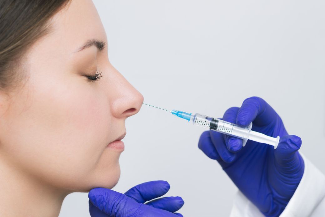 Rezultat de aliniere a puntii nazale prin injectare de acid hialuronic