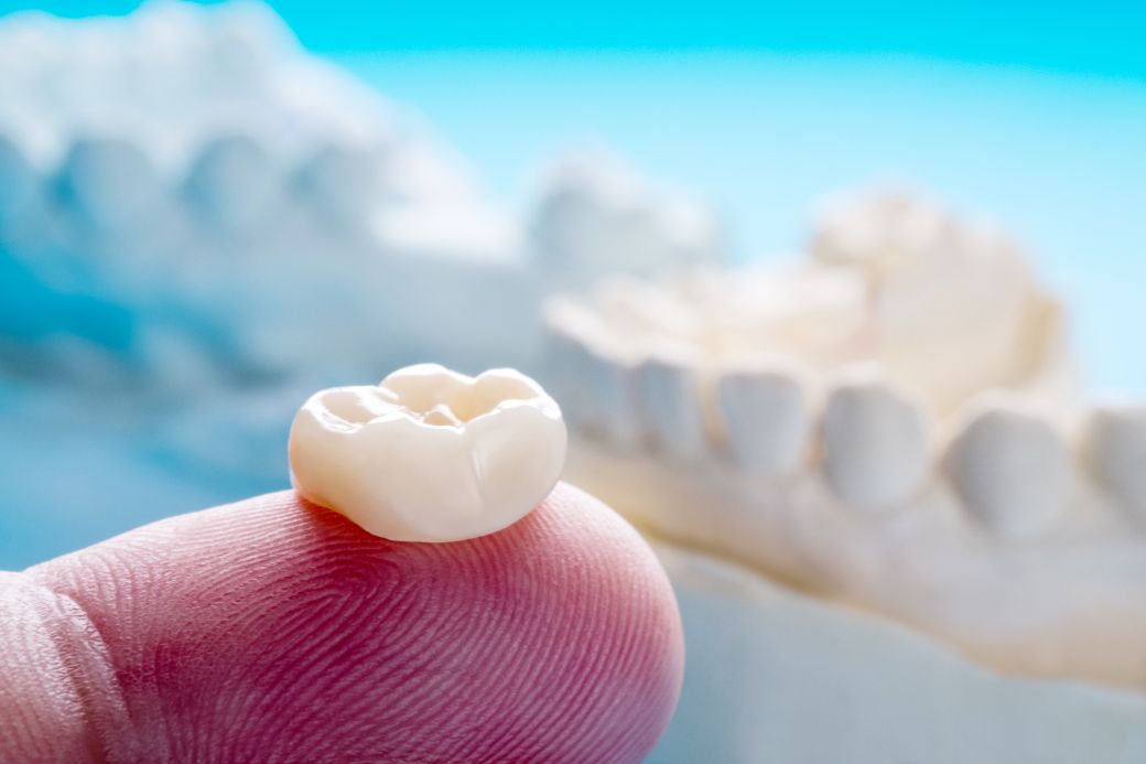 Coroană dentară din zirconiu care îmbracă complet dintele natural la Dr. Kurbe