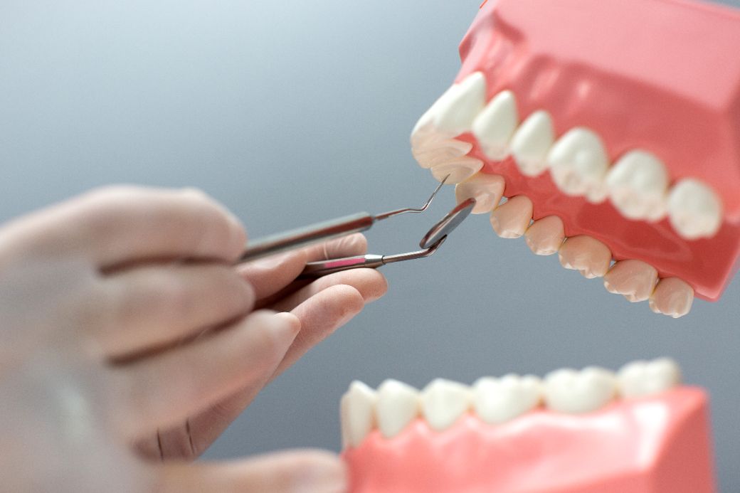 Igiena corecta si adaptarea coroanelor dentare la Clinica Dr Kurbe Bucuresti