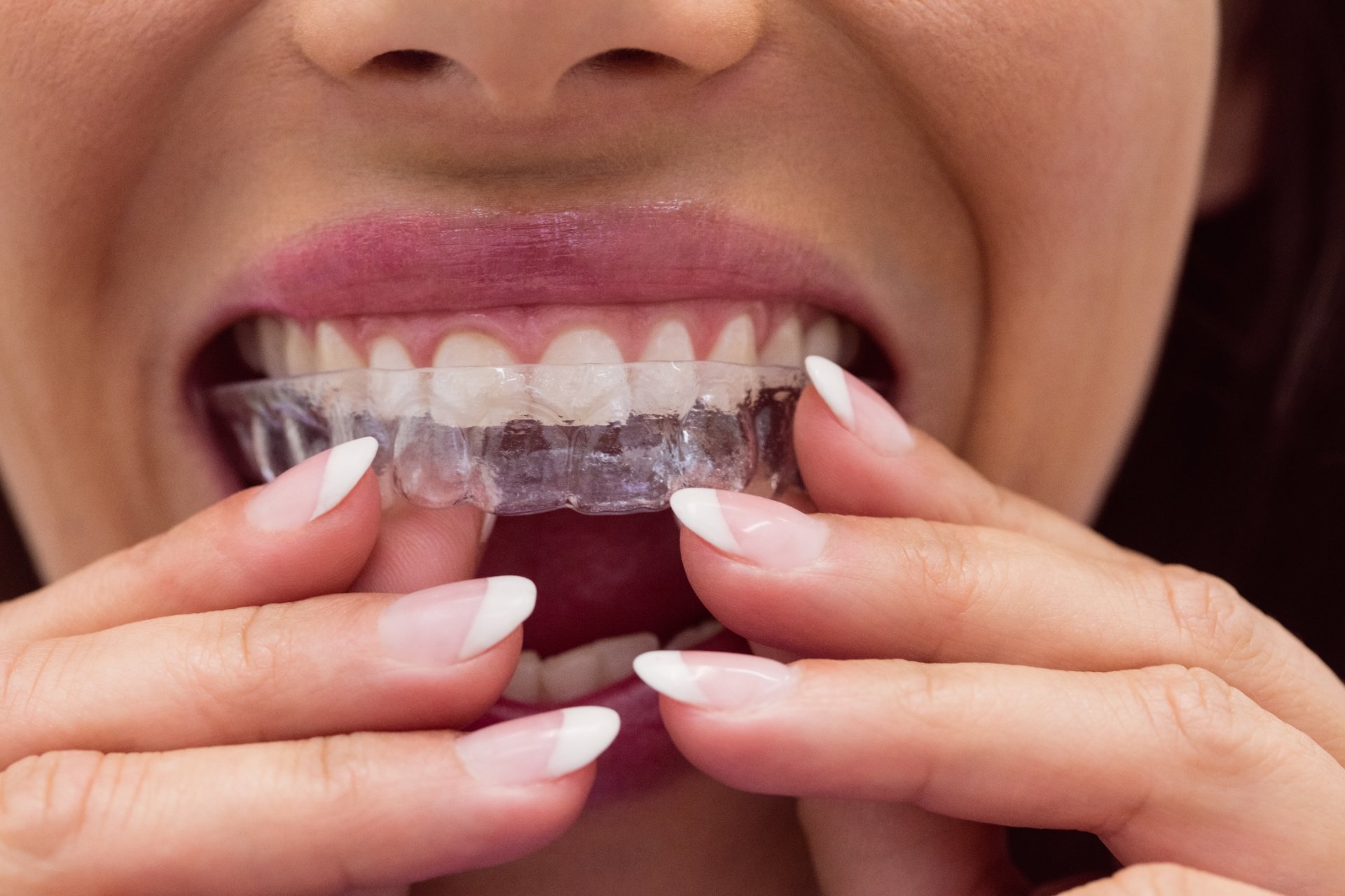 Gutiere transparente pentru aparat dentar invizibil, ținute în mână înainte de aplicare