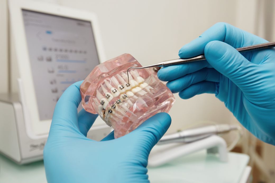 Aparat dentar fix aplicat pe arcada superioară în cadrul unui tratament ortodontic