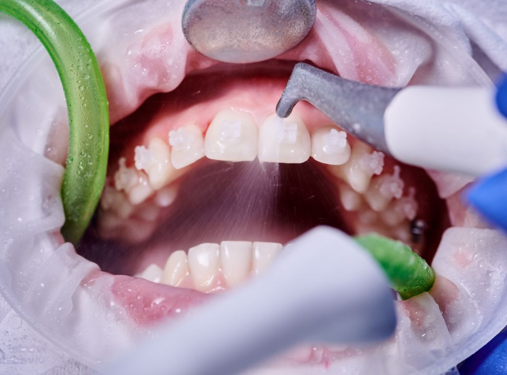 Tratamentul retractiei gingivale si al expunerii radiculare la Clinica Dr. Kurbe