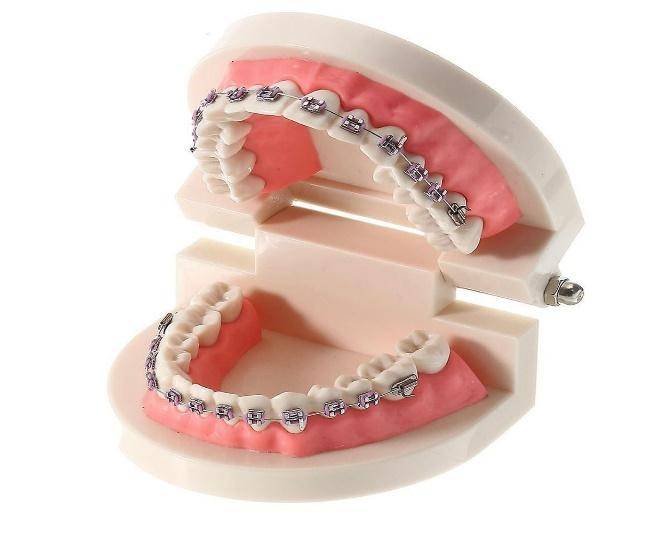 aparatul-dentar-blog