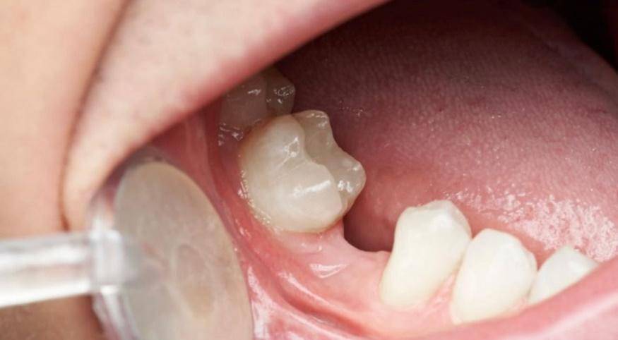 implant-dentar-poza