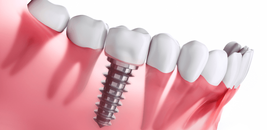Implant Dentar O soluție durabilă pentru inlocuirea dinților pierduți