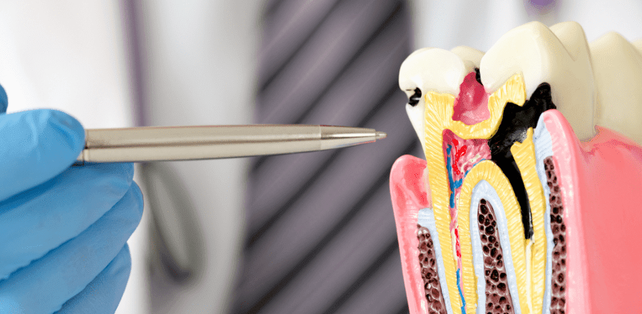 Tratarea Cariilor Dentare: Metode Eficiente și Tehnologii Avansate