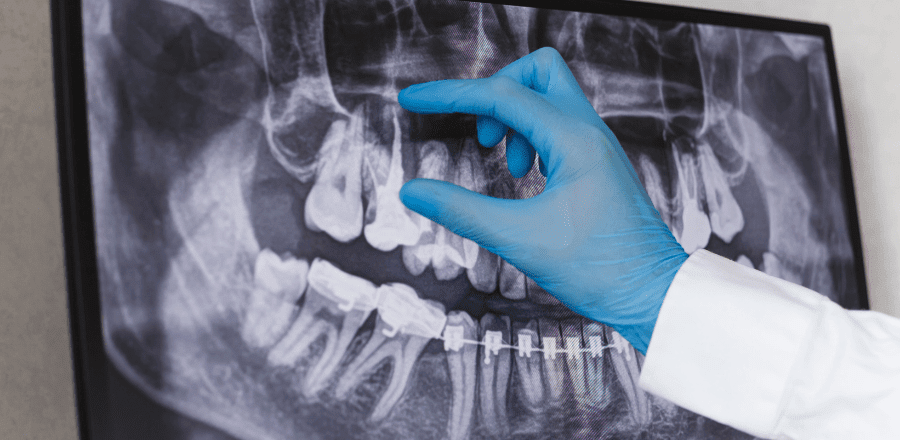 Radiologia Dentară: O privire detaliată asupra imagisticii în stomatologie