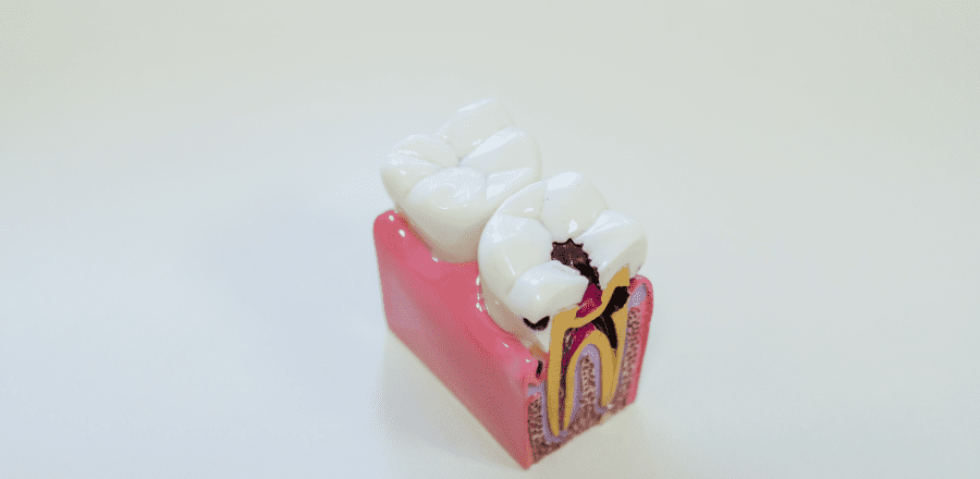 Cariile dentare și endodonția salvând zâmbete și eliminând durerea