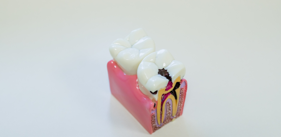 Dental caries and endodontics saving smiles and eliminating pain
