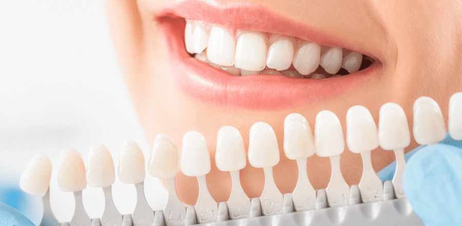 Albirea dintilor: Proceduri eficiente pentru un zâmbet sănătos