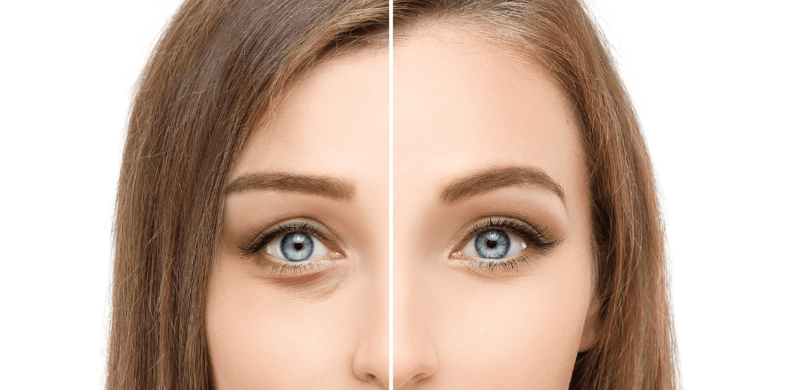 Blefaroplastie inferioara si superioara revigorarea privirii si imbunatatirea aspectului facial