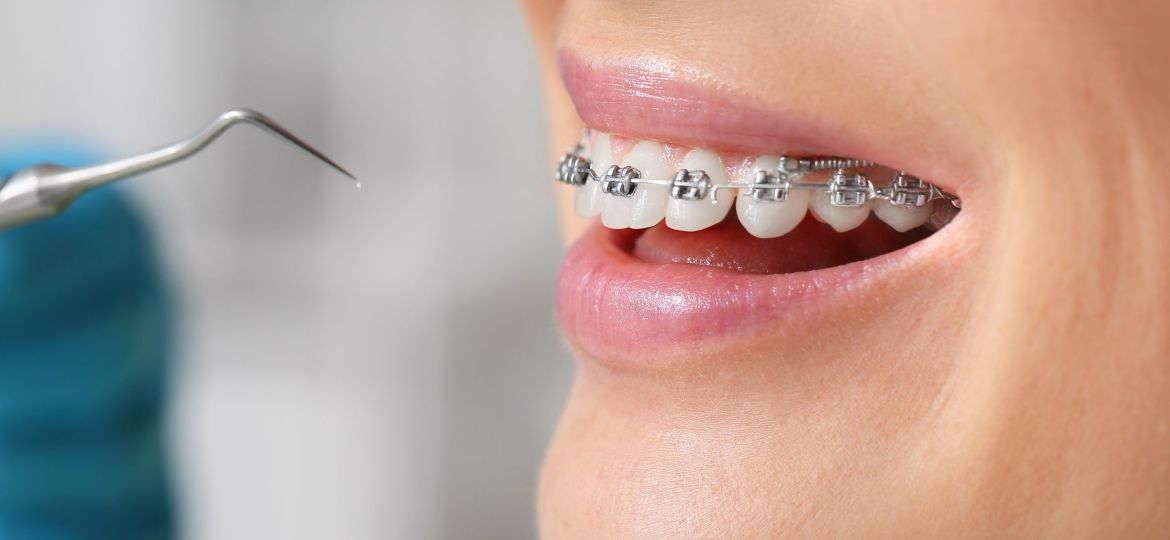 Woman,With,Dental,Braces,Visiting,Dentist,In,Clinic,,Closeup